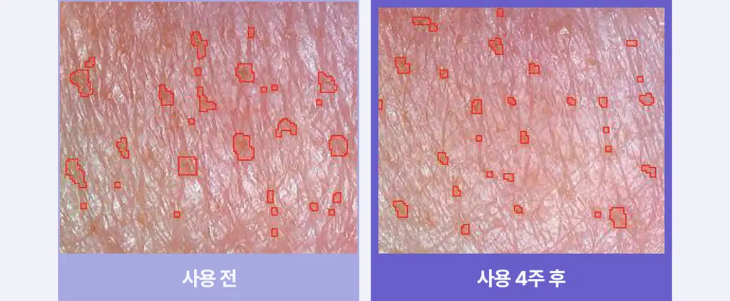 [5월 올영픽/9중 모공지표 개선/올리브영 단독 런칭] 리쥬란 더마 힐러 포어 타이트닝 겔 마스크 5매 상세페이지 37